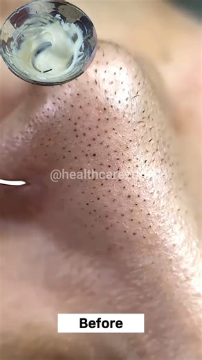 Rmove Blackheads & Whiteheads From Nose Easily At Home 💯✅ . . . #removeblackheads #whiteheads #blackheads #skincareroutine #reelsviralシ #fbreelsfypシ゚ #fypreels #reelsfacebook #explorepage | Health Care Zone