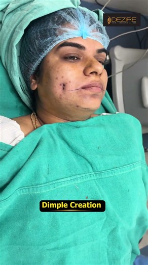Dimple Creation | Dimple Result