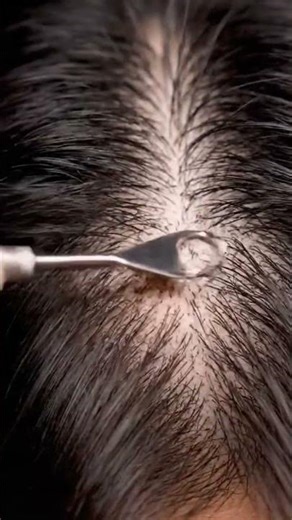 EXTREME Macro ASMR | Scalp Scratching & Dandruff Removal