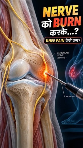 Nerve को Burn करके Knee Pain कैसे कम? 🔥 | Genicular RFA #shorts #genicularrfa #kneepain