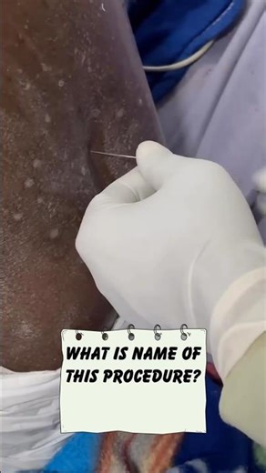 Lumber Puncture || #MedEd || #Medicaltok || #Diagnosis || #Rear_cases ||