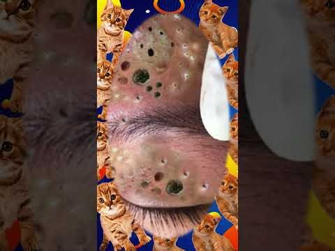 Blackheads Removal | Acne Treatment and Very Satisfying Satisfying Pimple pop #blackheads