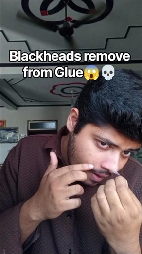 Glue remove Blackheads 😱💀 | New cream unlock 🔓