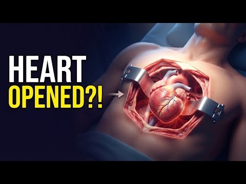 How Open-Heart Surgery Actually Works | From Chest Incision to Heart Repair| Explain In Just 1Minute