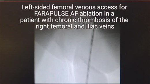 #pulsedfieldablation #atrialfibrillation #electrophysiology | Lucas Adrian