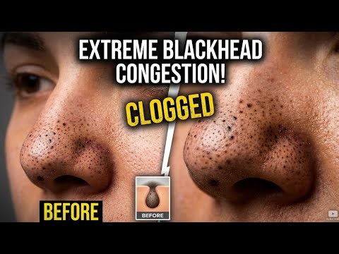 😱 The Biggest Blackheads You’ve Ever Seen! | Satisfying Blackhead Removal ASMR