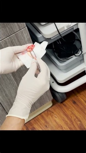 Why This Pilar Cyst Looks Like Egg Noodles