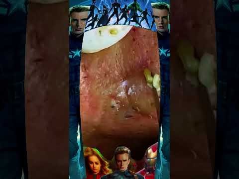 Blackheads Removal #616 | Acne Treatment and Very Satisfying Satisfying Pimple pop #blackheads