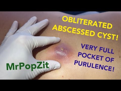 This Abscess obliterated the skin above it, leaving a giant hole in his back, see how it heals!