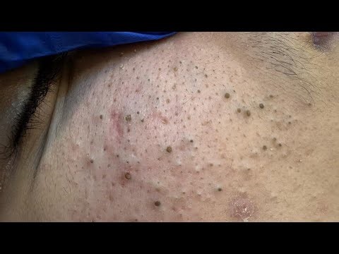 [ASMR] Deep Pore Cleansing and Blackheads Removal for Glowing Complexion