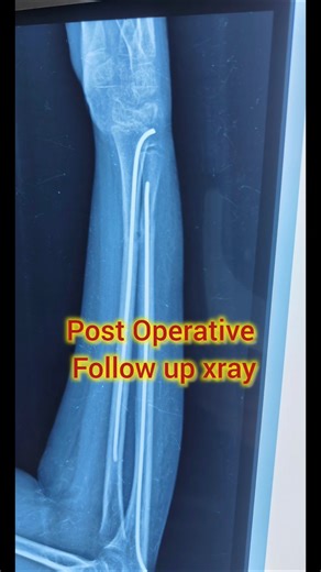 14 year Male Patient -Distal third Radius Ulna Fracture operated by Tens nail #Forearm Fracture mx