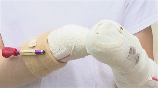 Missouri teen blows off hands in fireworks accident