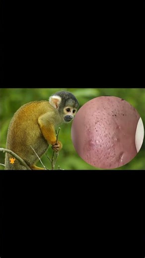 Removing Acne Blackheads on skin, cleaning everywhere
