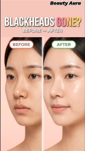 Blackheads Removal at Home ✨ | Clear Nose Fast 😍 | Beauty Aura #Shorts