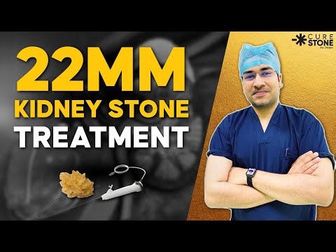 22mm Kidney Stone Treatment | 4 Failed Surgeries to Success, Patient Success Story from Shimla, RIRS