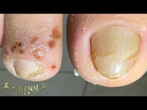 DISIDROSE E UNHA ENCRAVADA #satisfying #usa