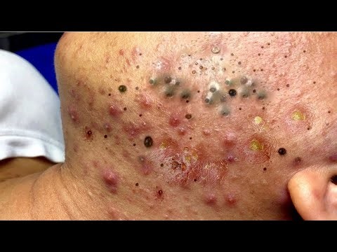 Satisfying Blackhead Removal – Deep Acne Cleaning for Ultimate Relaxation - 293419