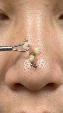 Extreme Nose Blackhead Extraction 😱 ASMR