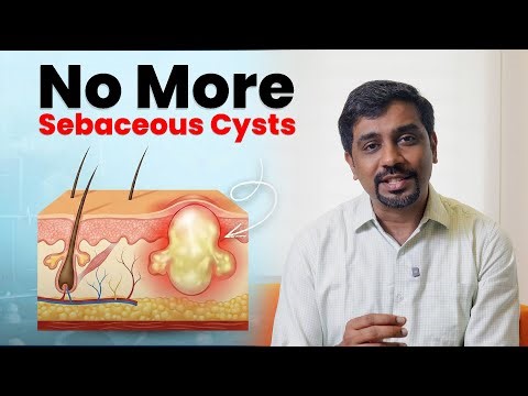 The Only Routine That Actually Works for Sebaceous Cysts Prevention