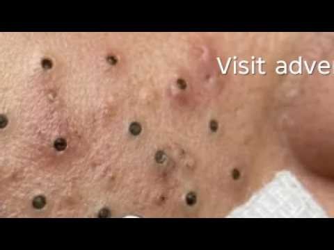 Deep blackhead Removal 2026, acne removal spa, big pimple 2026, #acne #pimple #cyst