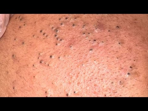 Part 1 biggest blackheads popped