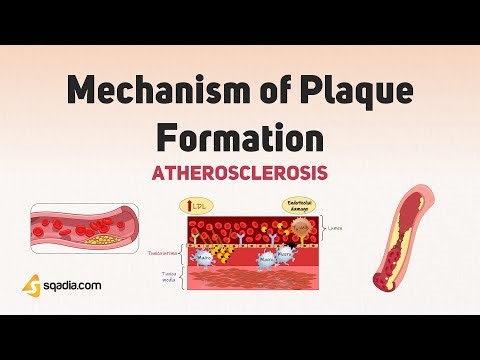 Atherosclerosis | Mechanism of Plaque Formation