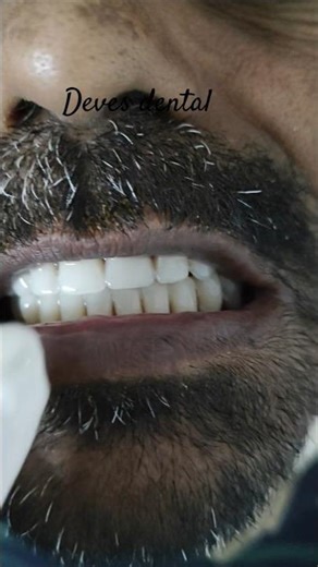 Complete Dentures: For when all teeth are missing in an arch (upper or lower).