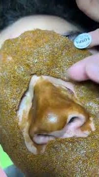 Nose Blackhead Removal Treatment 😍 | Whiteheads Clean | Satisfying Facial”