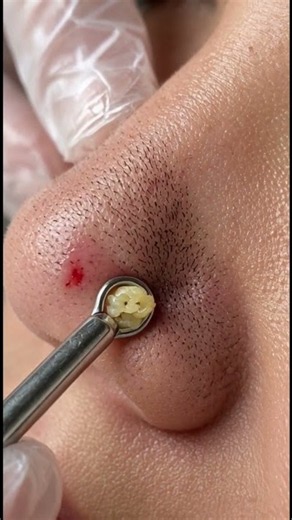 This Blackhead Was STUCK For Months