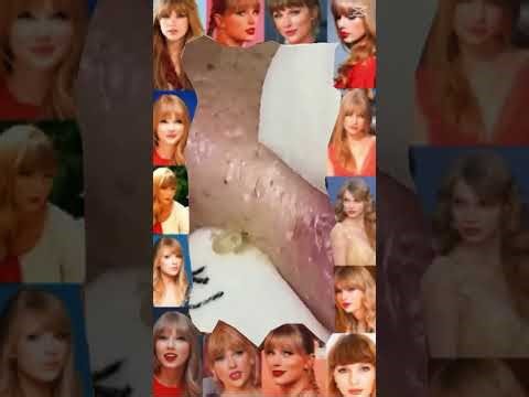 Blackheads Removal #325 | Acne Treatment and Very Satisfying Satisfying Pimple pop #blackheads