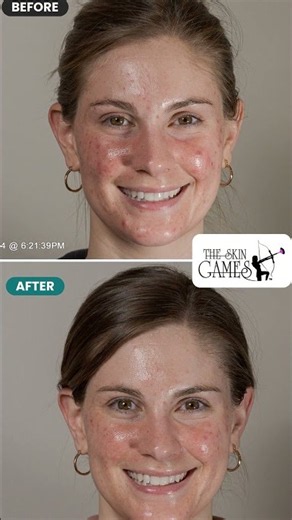 Acne Before & After | Esthetician Katie Dean #shorts