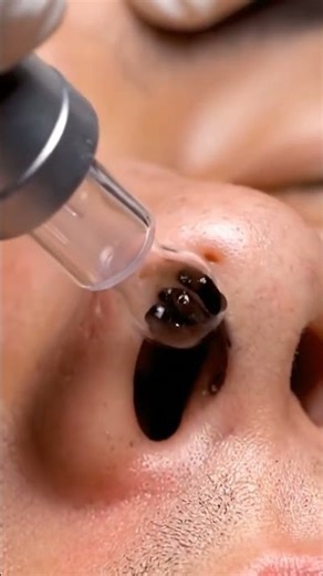 Spa Day Satisfying Nose Blackhead Extraction ASMR