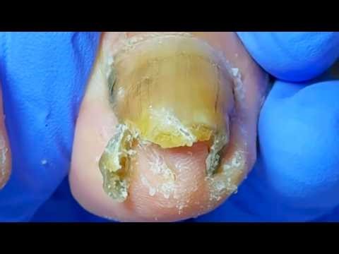 Severe Fungal Infection, Black Mud All Over The Nails, Professional Pedicure【Dr Liu's Pedicur】