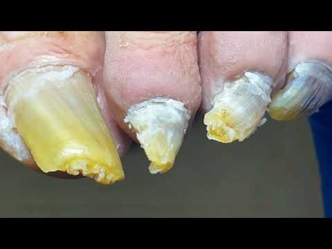 Yellow And Long Toenails, Perfect Trimming Process【Pedicure Master Lin Jun】