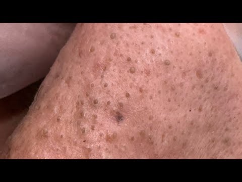 How To Use Anua Heartleaf Quercetinol Foam For Blackhead Removal