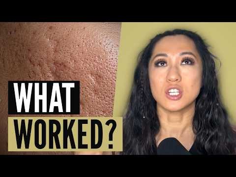 I Tried Almost Every Acne Scar Treatment - Here's What Worked