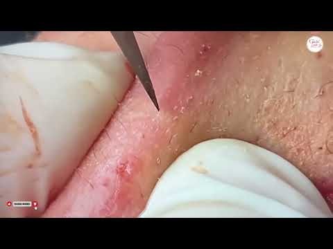 Extreme Blackhead Removal for a Peaceful Mind #82308184