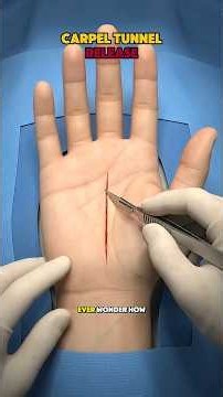 carpel tunnel release surgery explained(3d animation)_open vs endoscopic #shortvideo