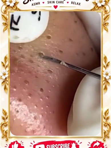 Deep Blackhead Extraction & Satisfying Popping | Wait for the most satisfying pop 😳🫣 You won’t believe what comes out! #pimplepoppersatisfying #Acne #pimple #Blackhead #Satisfying