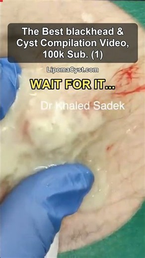 Best Blackhead Compilation. Click link 👇Dr Khaled Sadek. LipomaCyst.com