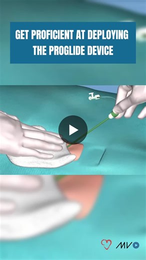 #cathlab #perclose #vascularclosure #interventionalcardiology #structuralheart #cathlabtech #cathlabnurse #medicalvisual #cardiovisual | CardioVisual