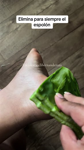 Tratamiento natural para espolón de talón