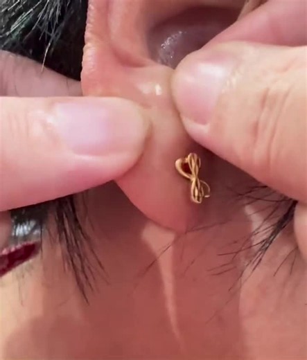 Satisfying Pimple Popping Video | Popping & Tik Tok Trend