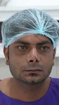 Broken Nose Correction with Rhinoplasty