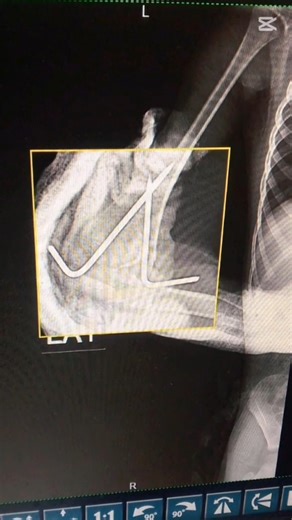 closed k wire fixation of Type ll Supracondylar fracture humerus in child #health #ortho #children