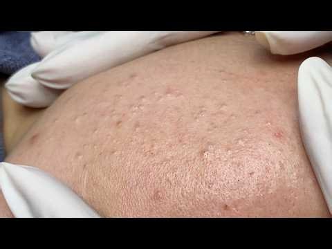 Clearing Up Acne for Middle-Aged Women | Loan Nguyen Acne Treatment Official