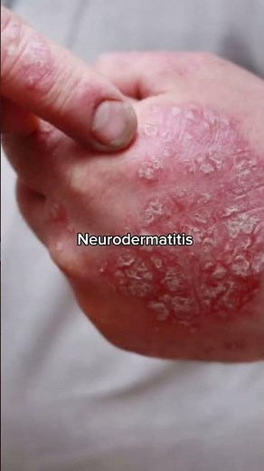 ¿Sabías que existen 7 tipos de eczema? 🤔