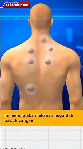 Terapi bekam untuk kesehatan