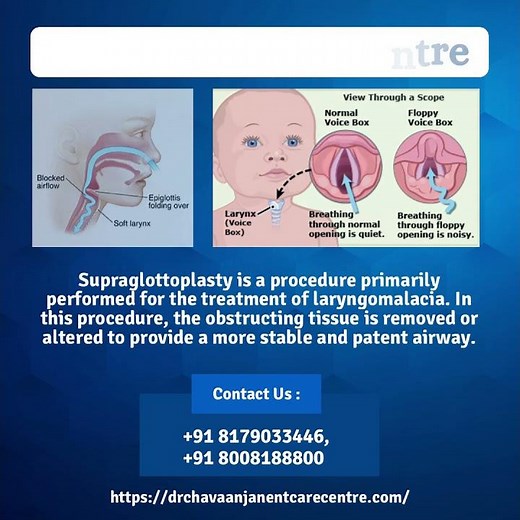 Supraglottoplasty For Laryngomalacia | Dr. Chava Anjaneyulu | Chief ENT Surgeon | ENT Specialist