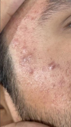 Sac be spa blackhead removal with ASMR scrub facial #4k #spafacial #asgharbarber #asmr #barber